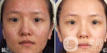 光子嫩膚能去痘印嗎、光子嫩膚去痘印*果怎么樣？