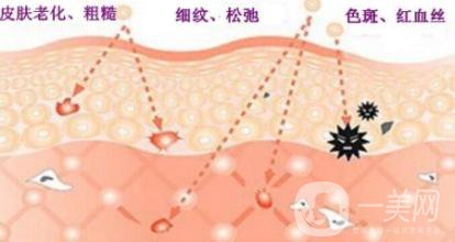 做光子嫩膚有什么作用和好處？