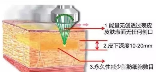 做超聲波吸脂手術的時候疼嗎？