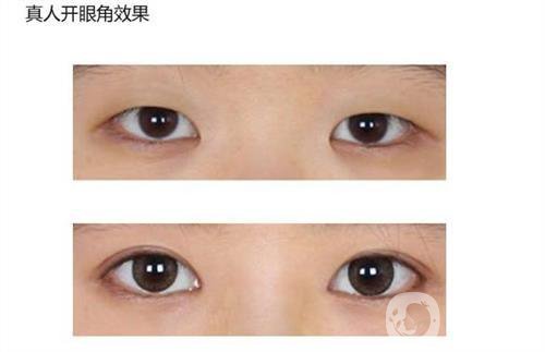 做開眼角手術(shù)需要多少錢？