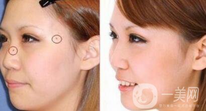 激光點(diǎn)痣大概多少錢？激光祛痣的價(jià)格詳解