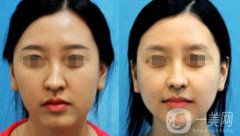 歪鼻矯正需要多少錢？上海歪鼻矯正價格詳解