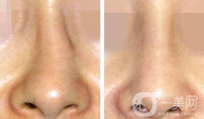 歪鼻矯正需要多少錢？上海歪鼻矯正價格詳解
