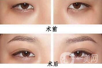 韓式開(kāi)眼角哪*果好？哪個(gè)醫(yī)院做韓式開(kāi)眼角比較好
