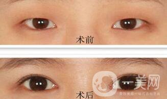 韓式開(kāi)眼角哪*果好？哪個(gè)醫(yī)院做韓式開(kāi)眼角比較好
