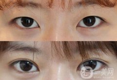 做高分子雙眼皮多少錢(qián)？高分子雙眼皮價(jià)格介紹
