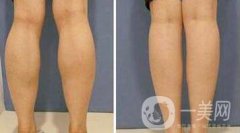 注射瘦臉要多少錢(qián)？注射注射瘦臉價(jià)格詳細(xì)介紹