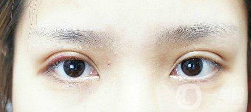 眼睛埋線幾年后的危害有些什么？