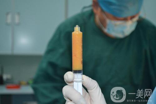 自體脂肪臉部填充*果可以維持多久？