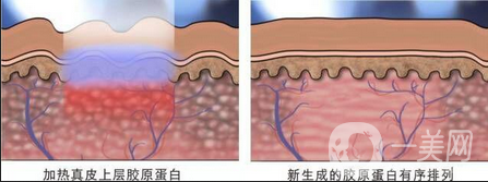 做像素激光調(diào)節(jié)痘疤一般多少錢？