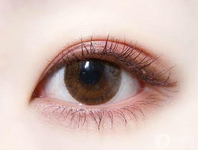 高分子雙眼皮