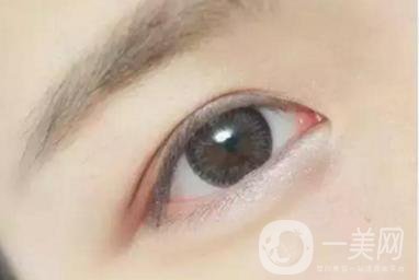 做完韓式三點雙眼皮之后眼睛會腫嗎？