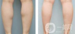注射瘦腿*果嗎、注射瘦腿有副作用嗎