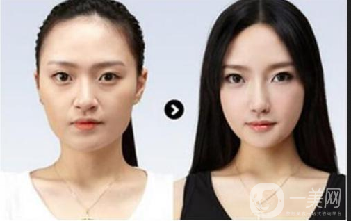 做完墊鼻梁硅膠*果能堅(jiān)持幾年？