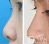 耳軟骨墊鼻尖手術(shù)做完需要多久恢復(fù)正常？