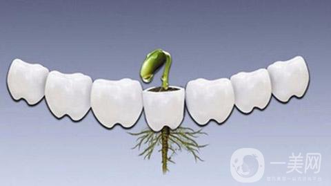 做一次種植牙的價(jià)格 費(fèi)用貴嗎？