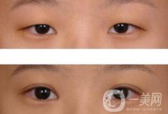 威海割雙眼皮多少錢？雙眼皮手術(shù)價(jià)格詳解