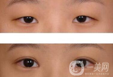 威海割雙眼皮多少錢？雙眼皮手術(shù)價格詳解