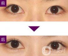 三點(diǎn)定位雙眼皮手術(shù)有副作用嗎、果怎么樣