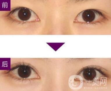 三點定位雙眼皮手術有副作用嗎、*果怎么樣