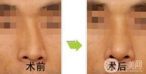 矯正鼻子大概多少錢？矯正鼻子多少費用詳情