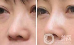 上?？s小鼻頭手術(shù)多少錢 縮小鼻頭整形價(jià)格介紹