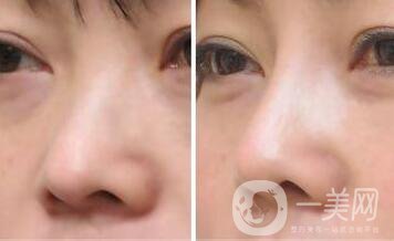 上?？s小鼻頭手術(shù)多少錢 縮小鼻頭整形價格介紹