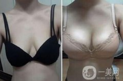 娜高假體隆胸多少錢(qián) 上海娜高假體隆胸價(jià)格詳解