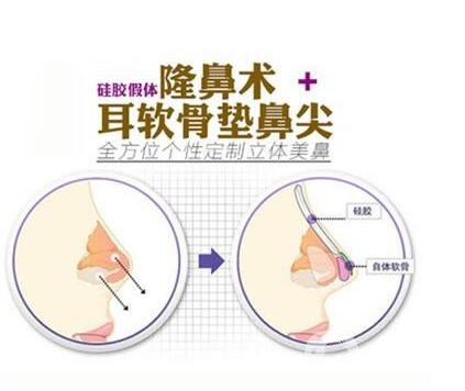 北京,耳軟骨墊鼻尖,價格