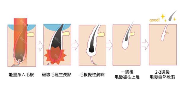 做一次激光脫毛的價(jià)格大概要多少錢？