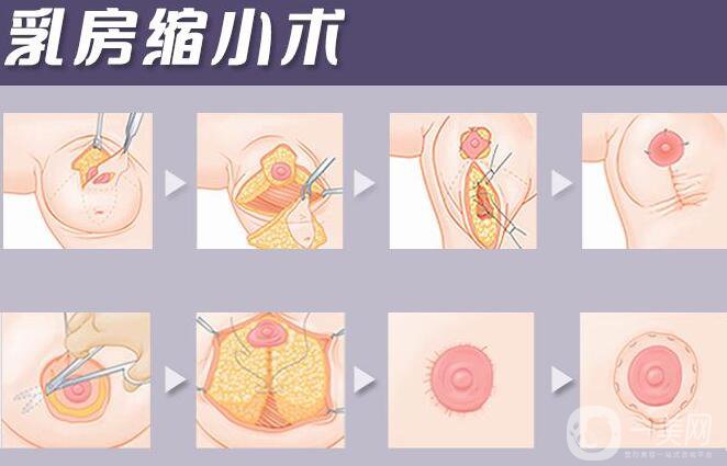 巨乳縮小