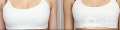 上海副乳切割手術(shù)多少錢 副乳切除手術(shù)價格詳解