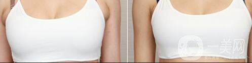 上海副乳切割手術(shù)多少錢 副乳切除手術(shù)價格詳解