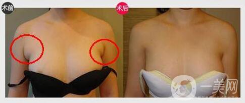 上海副乳切割手術(shù)多少錢 副乳切除手術(shù)價格詳解