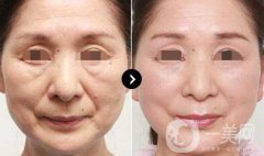 伊維蘭填充除皺價格 伊維蘭填充除皺多少錢