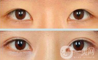 割雙眼皮疼不疼？打了麻藥還疼嗎？