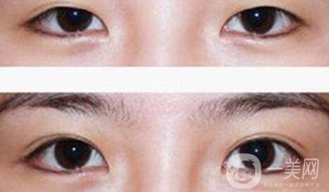 割雙眼皮疼不疼？打了麻藥還疼嗎？