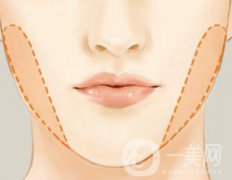 去頰脂墊多久恢復(fù) 與哪些因素有關(guān)？