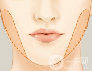 去頰脂墊多久恢復(fù) 與哪些因素有關(guān)？