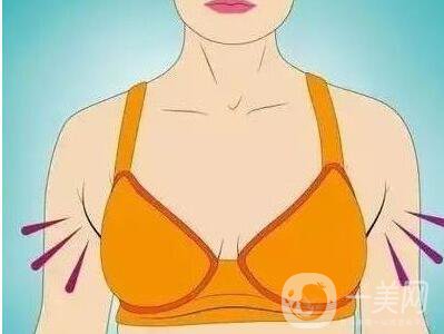 副乳吸脂,后遺癥