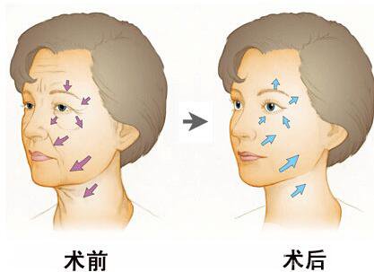 伊維蘭除皺要多少錢 價格是多少