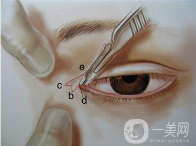 韓式開(kāi)眼角價(jià)格 韓式開(kāi)眼角多少錢(qián)