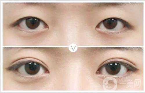 割雙眼皮和埋線哪個*果比較好？