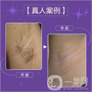 激光脫毛多少錢一次比較合理？