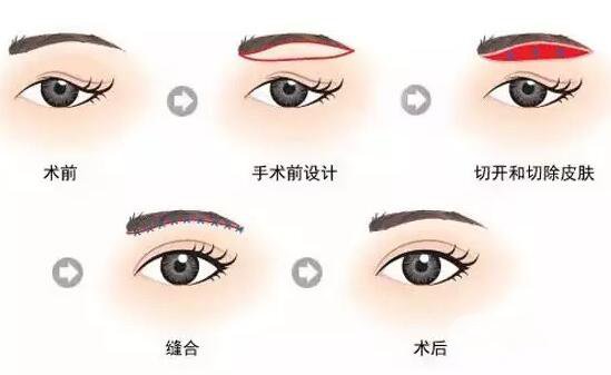 廣東眉整形價格多少 眉整形要多少錢