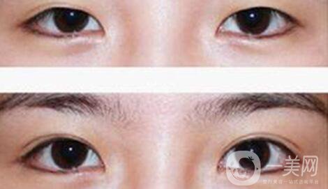 八月割雙眼皮會發(fā)炎嗎 雙眼皮術(shù)后護理事項介紹