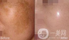 如何去除妊娠斑 去妊娠斑多少錢(qián)