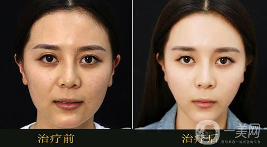 醫(yī)院果酸換膚多少錢 價(jià)格詳情