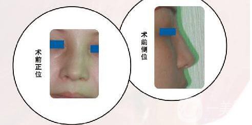 廣東,鼻骨矯正術,多少錢