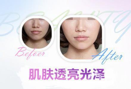 果酸換膚的功* 有哪些好處？